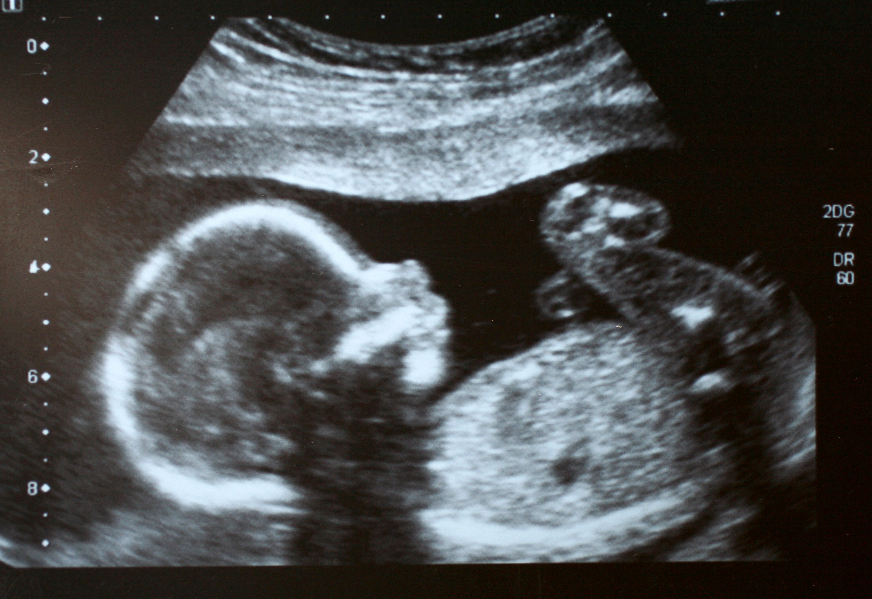 sonography image